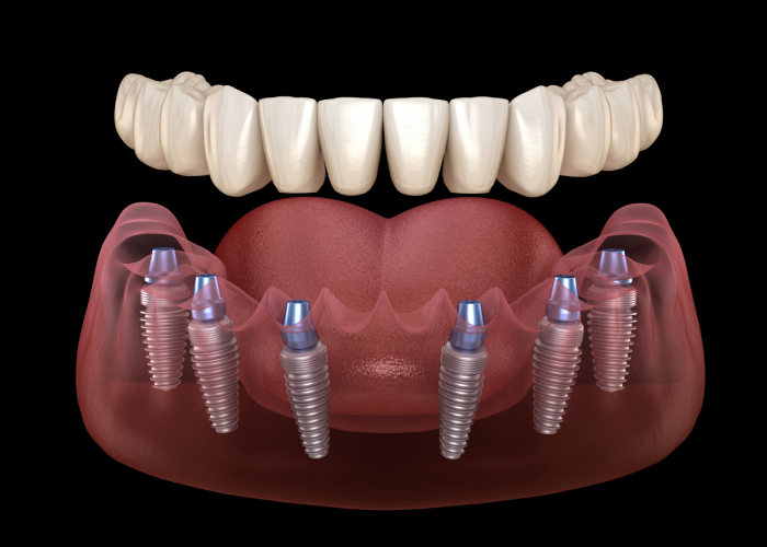 Cost of Full Mouth Dental Implants