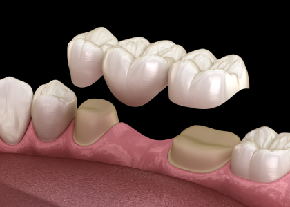Dental Bridge
