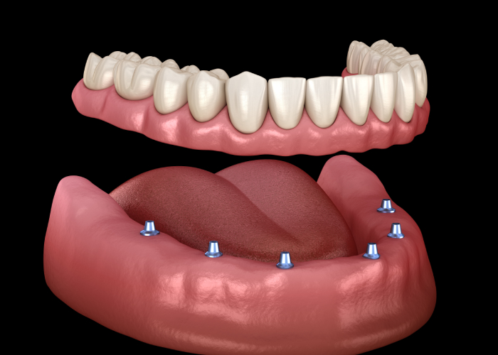 Full Mouth Dental Implants Cost