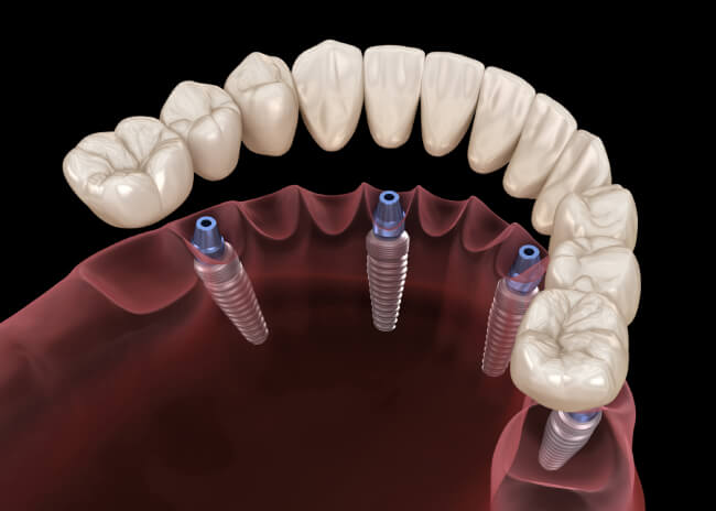 Dental Implant Cost