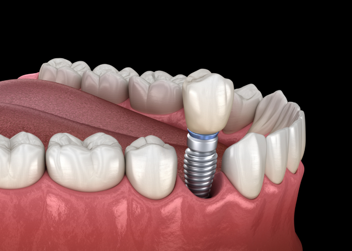 Dental Implant Service Provider 